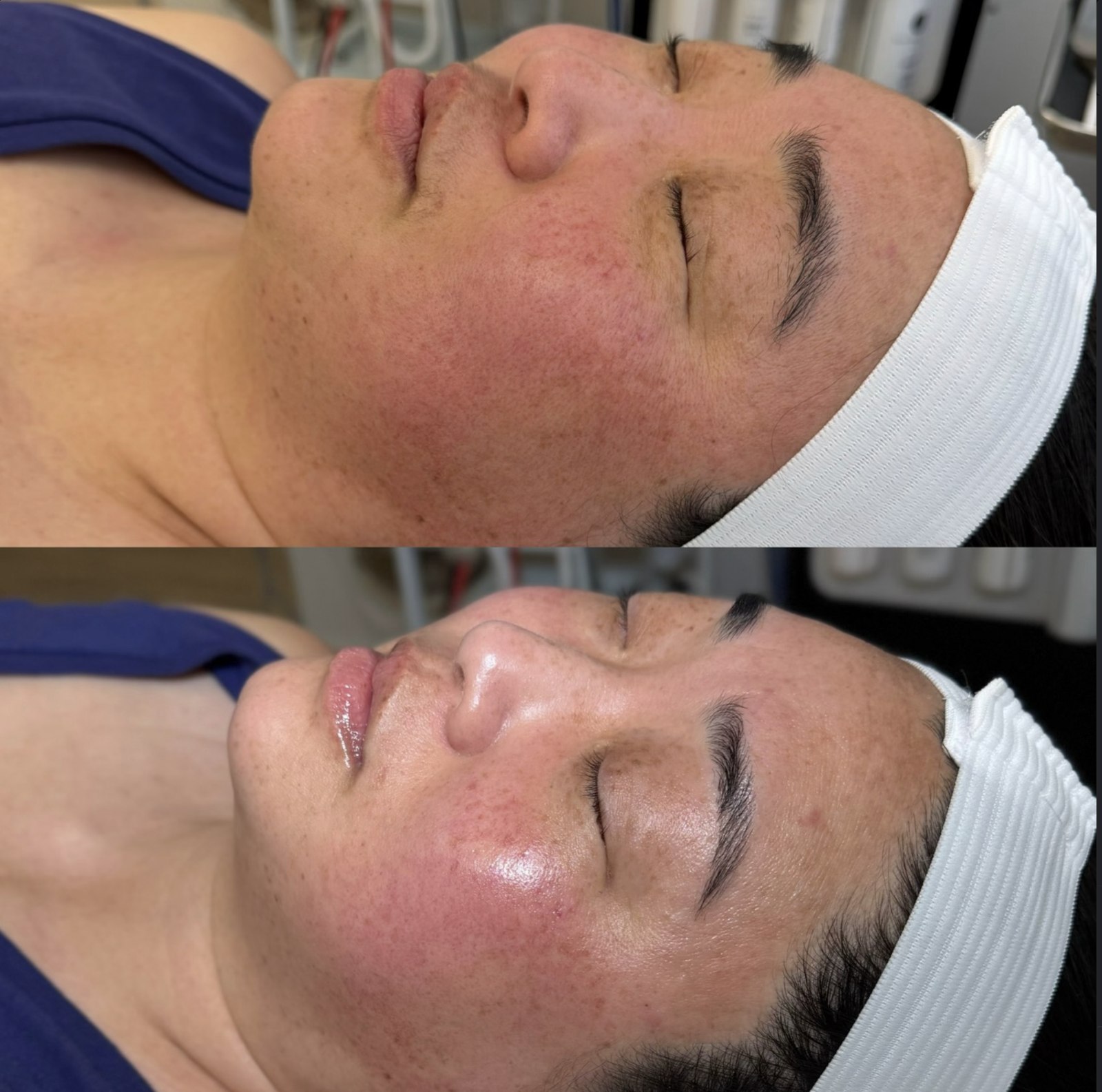 Before and after facial treatment by Sia Miller